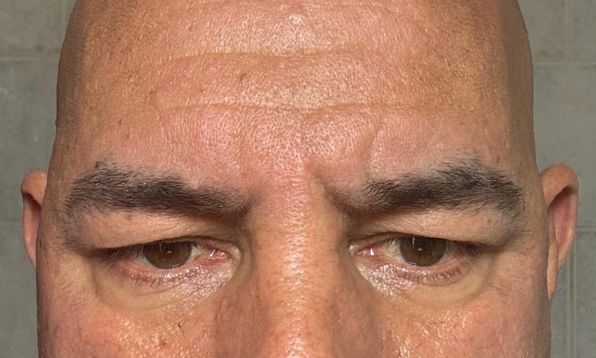 Blefaroplastia 1 - Antes