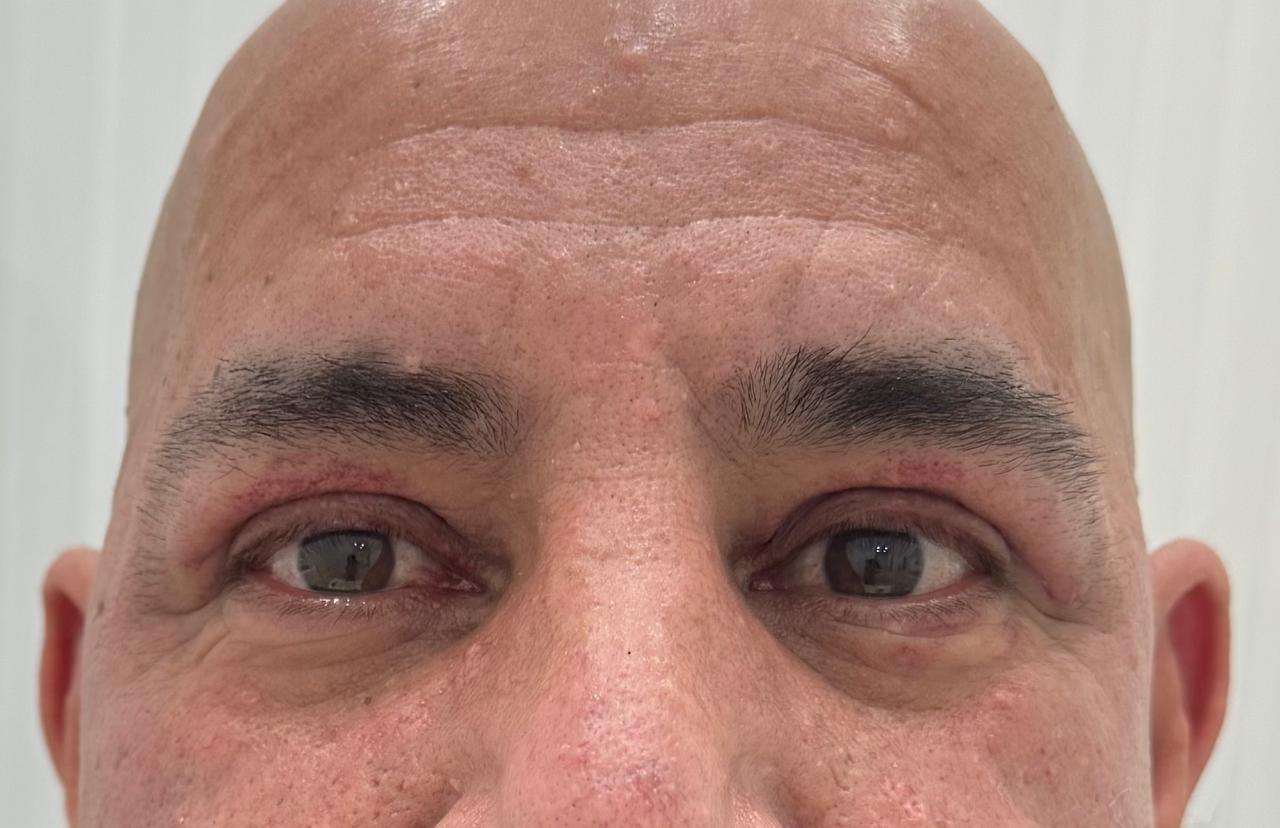Blefaroplastia 1 - Después