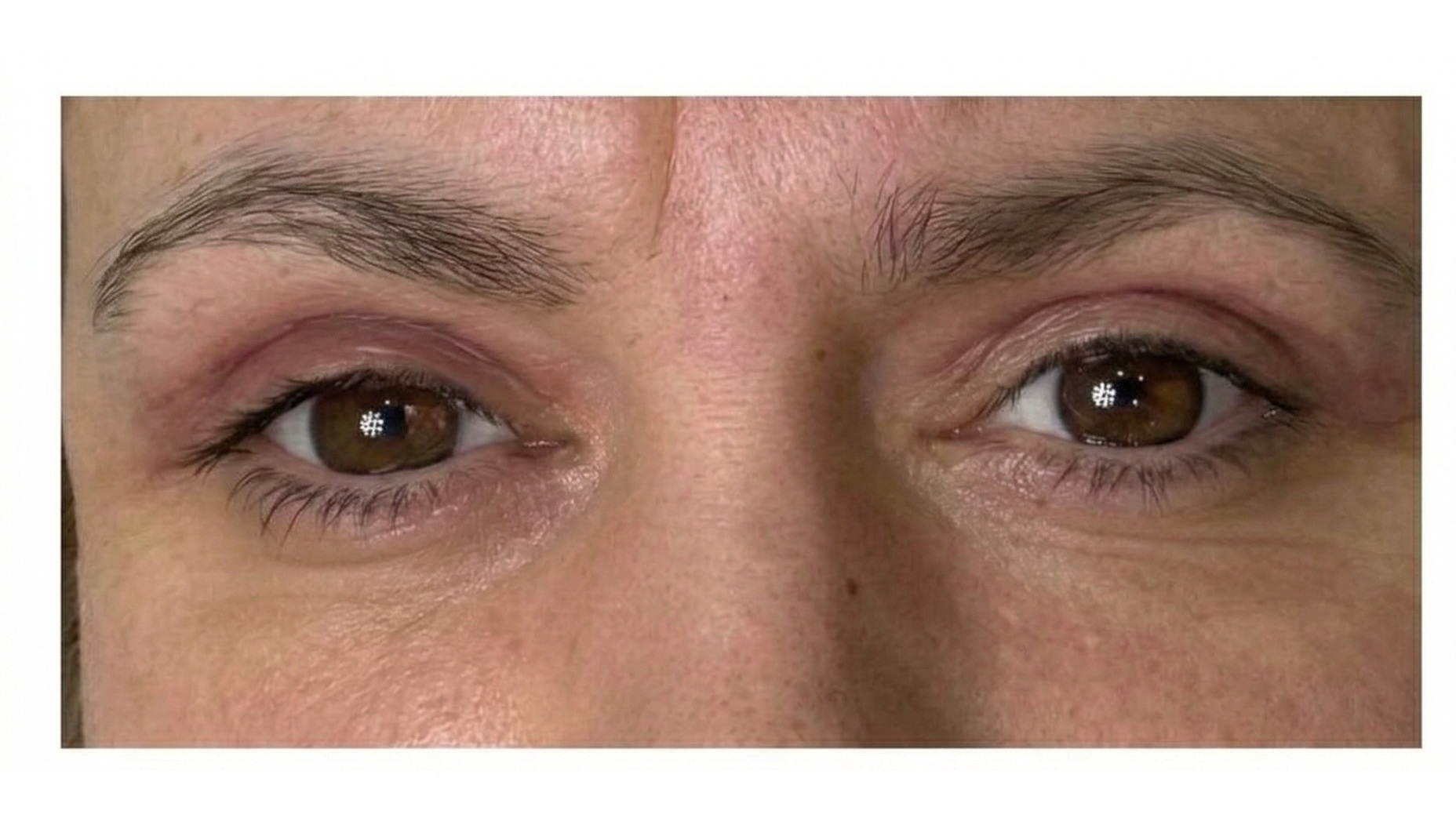 Blefaroplastia 3 - Después
