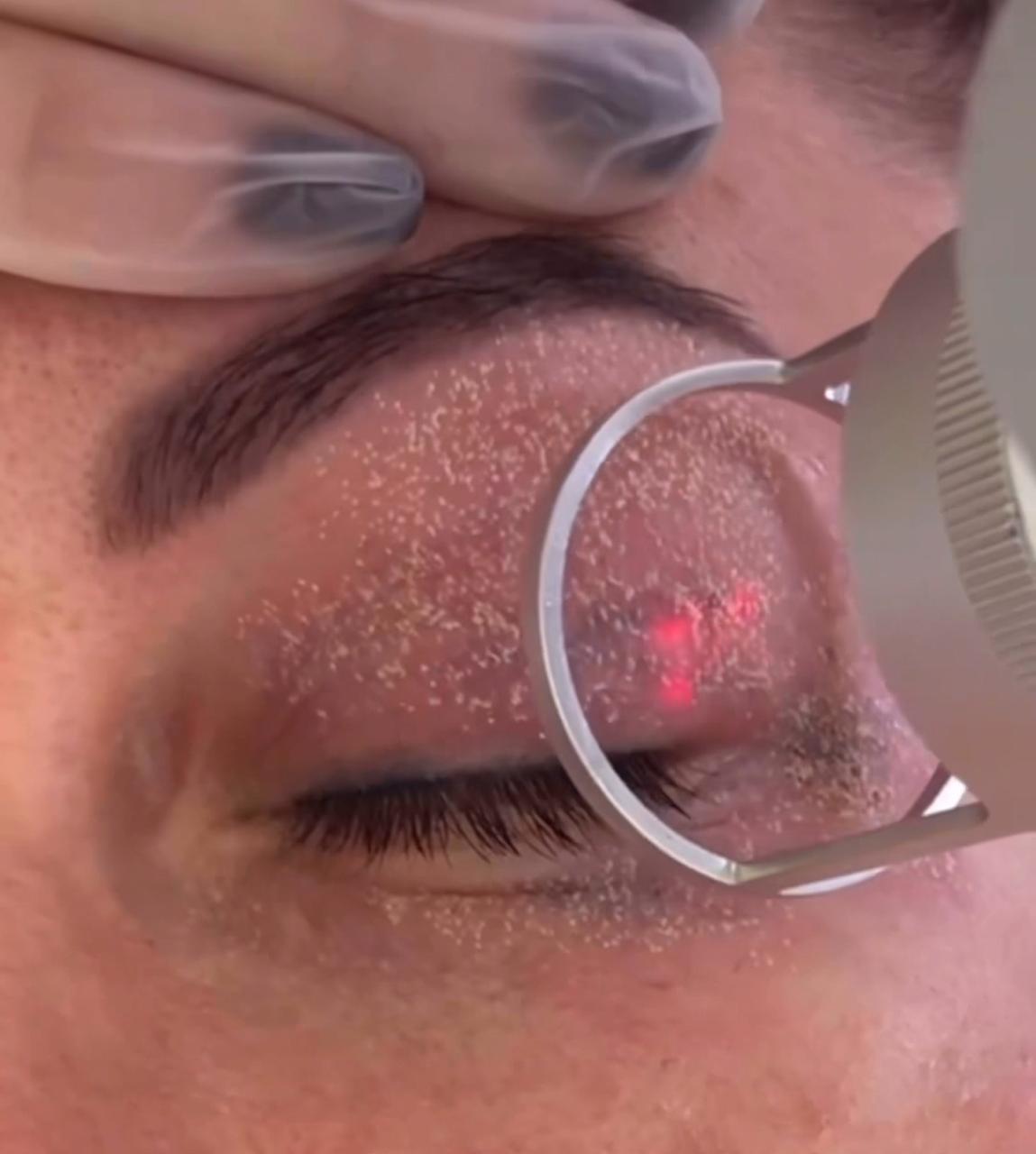 Dra. Sandoval aplicando Láser CO2 Fraccionado