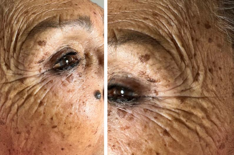 Caso 1: Antes del tratamiento con CO2