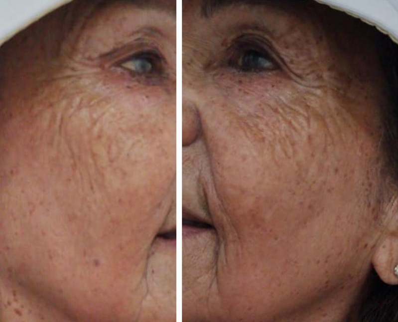 Caso 1: Después del tratamiento con CO2