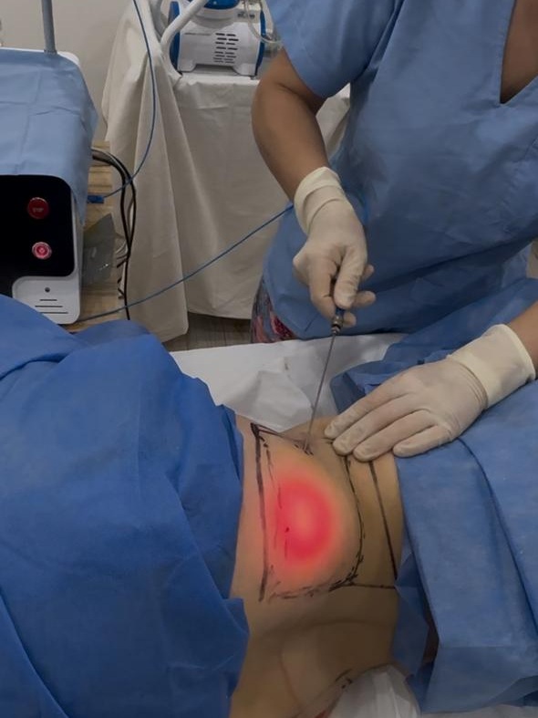 Procedimiento Endoláser