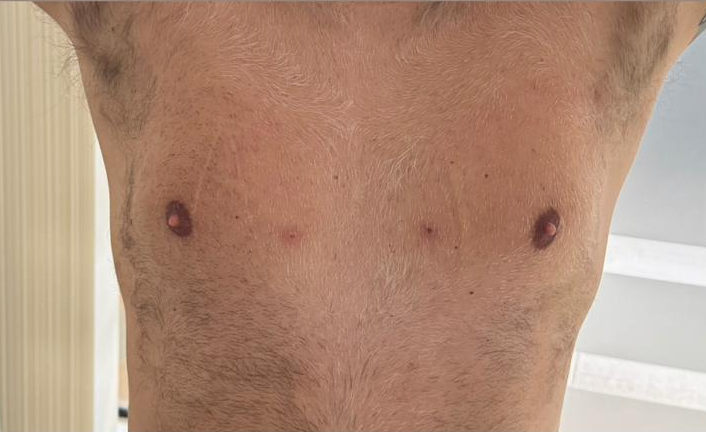 Ginecomastia Después