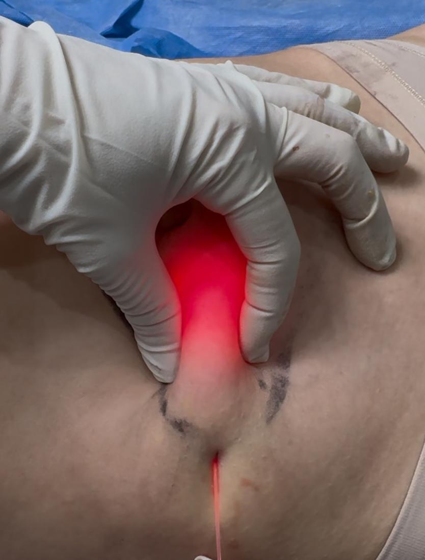 Endoláser Lipólisis