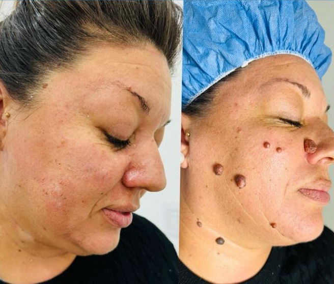 Exéresis de lunares antes y después