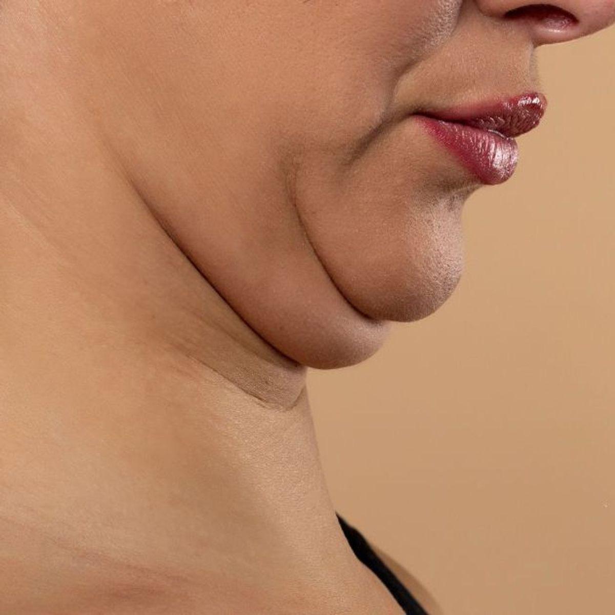 Lipo Papada detalle clínico