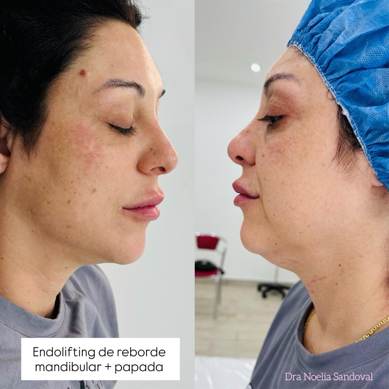 Lipo Papada reborde mandibular