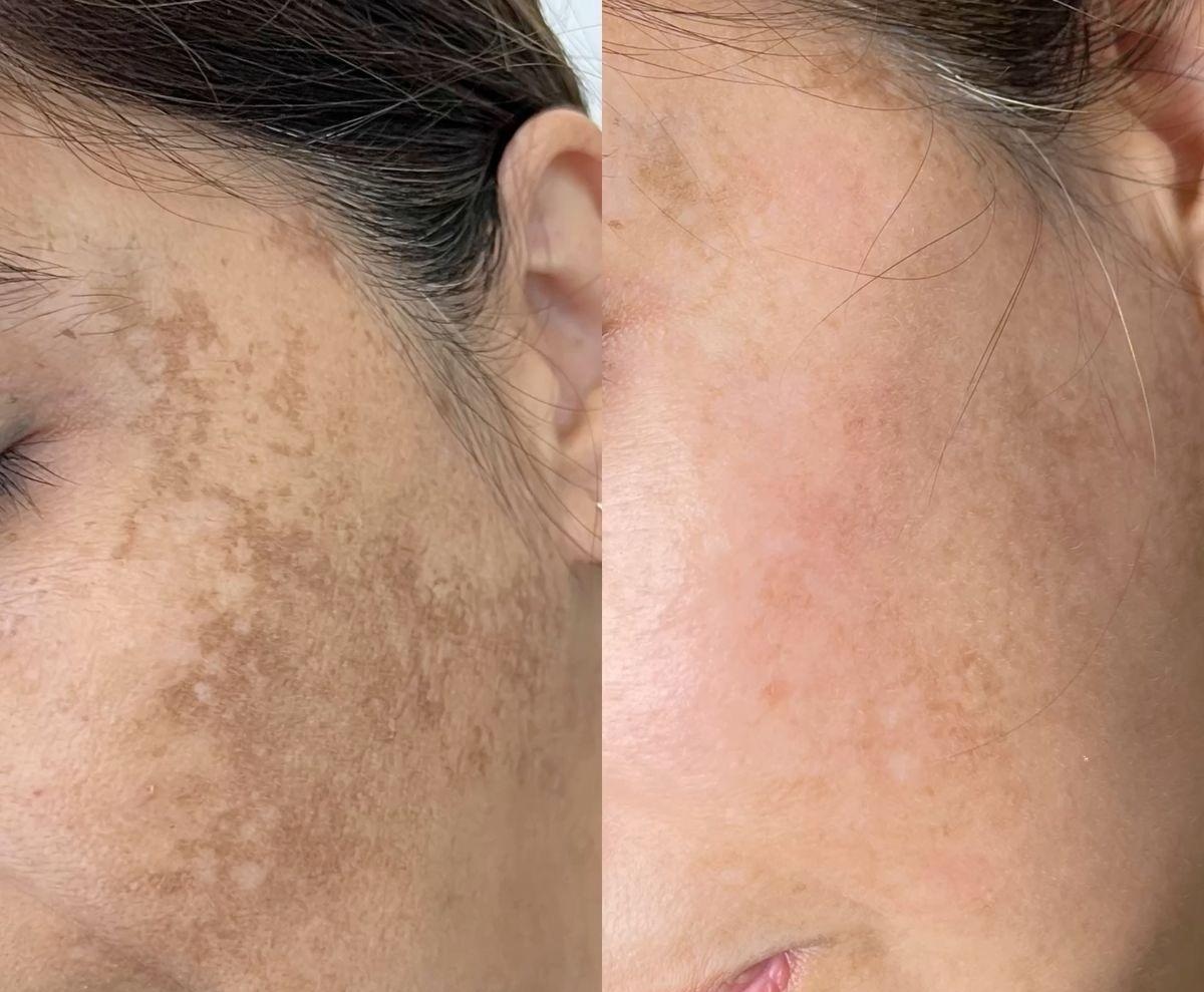 Tratamiento Picosegundo - Antes y Después