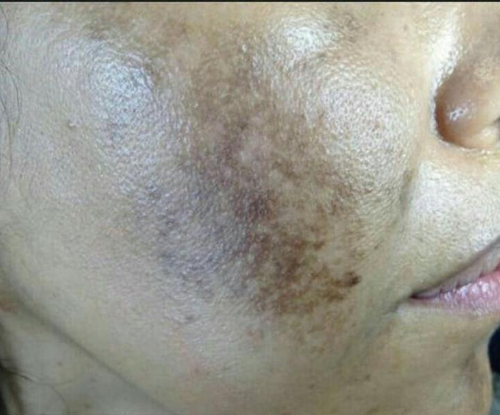 Tratamiento Picosegundo - Caso clínico antes