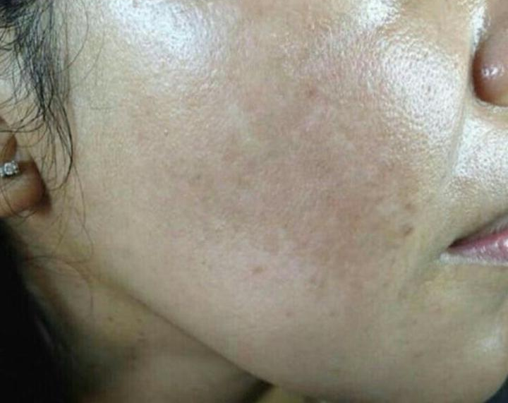 Tratamiento Picosegundo - Caso clínico después