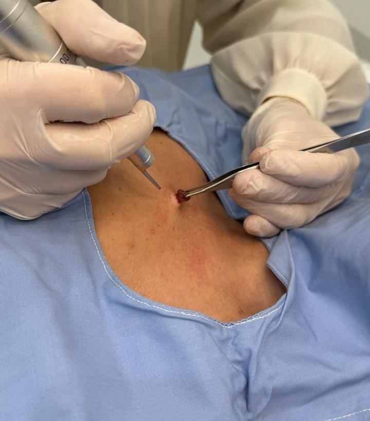 Tratamiento de lesiones pigmentadas