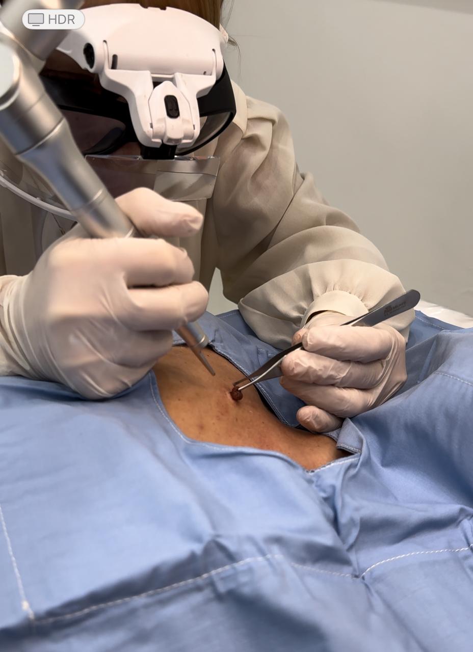 Resultado de remoción de tatuajes