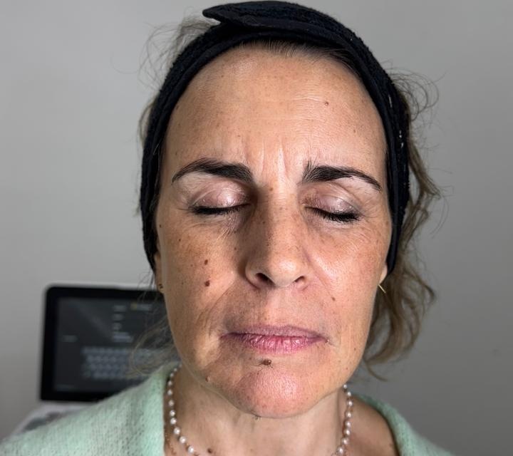 Ultherapy result 1