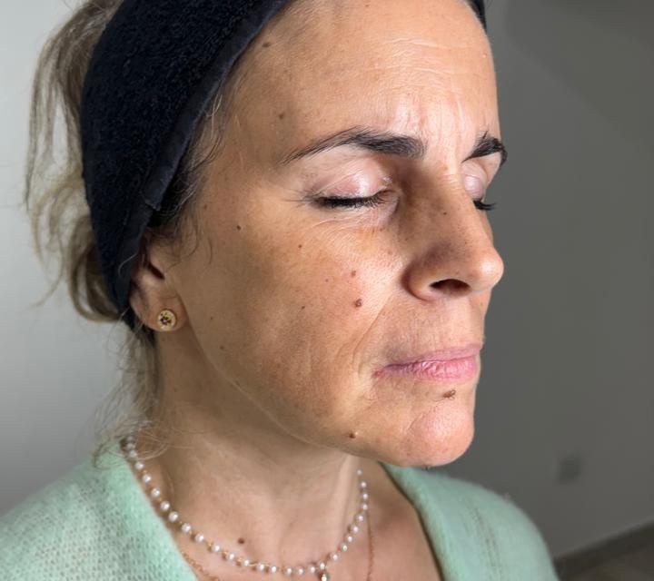 Ultherapy result 3