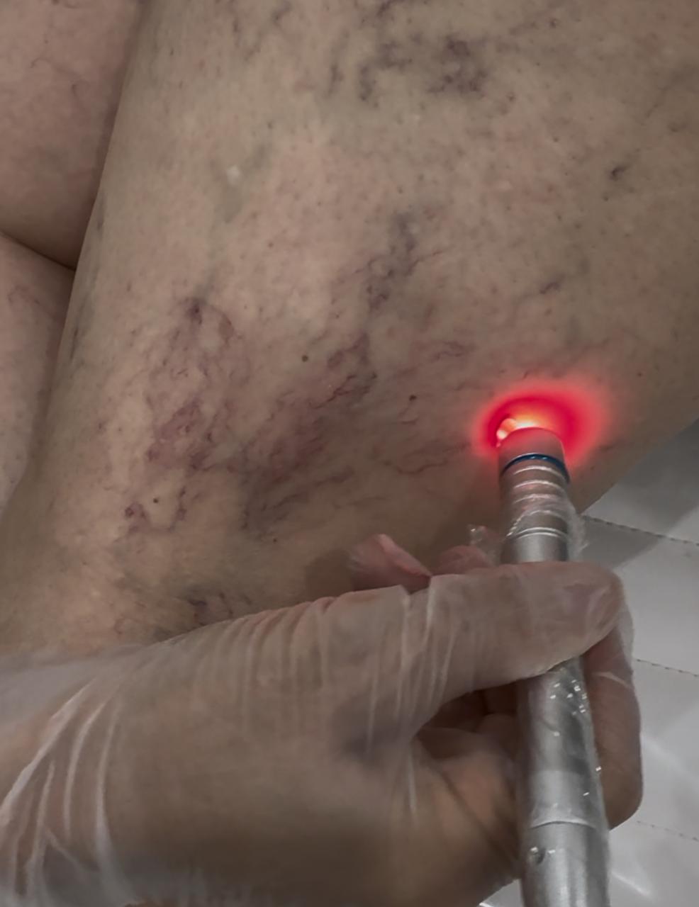 Procedimiento de Láser Vascular